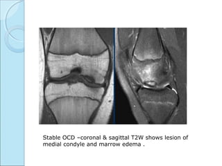 Stable OCD –coronal & sagittal T2W shows lesion of
medial condyle and marrow edema .
 