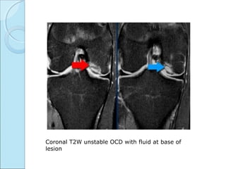 Coronal T2W unstable OCD with fluid at base of
lesion
 