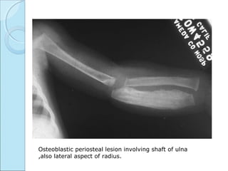 Osteoblastic periosteal lesion involving shaft of ulna
,also lateral aspect of radius.
 