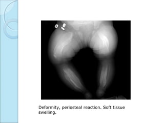 Deformity, periosteal reaction. Soft tissue
swelling.
 