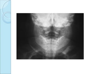 Osteochondritis dessicans ,caisson disease, caffey’s disease