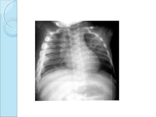 Osteochondritis dessicans ,caisson disease, caffey’s disease