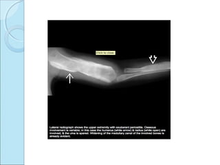 Osteochondritis dessicans ,caisson disease, caffey’s disease