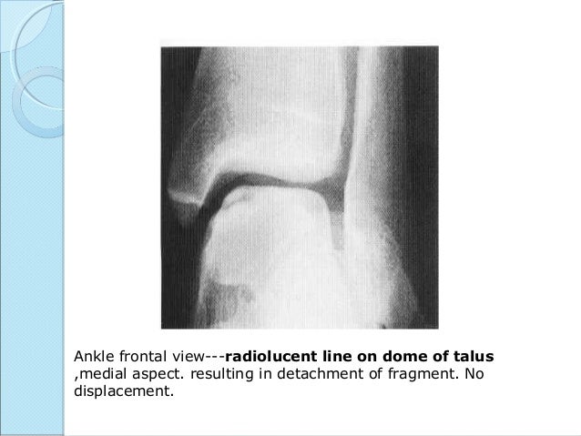 osteochondritis dessicans caisson disease caffey s disease caisson disease