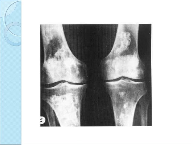 osteochondritis dessicans caisson disease caffey s disease caisson disease