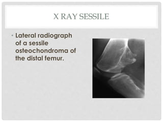 X RAY SESSILE
• Lateral radiograph
of a sessile
osteochondroma of
the distal femur.
 