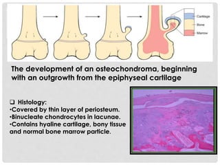 The development of an osteochondroma, beginning
with an outgrowth from the epiphyseal cartilage
 Histology:
•Covered by thin layer of periosteum.
•Binucleate chondrocytes in lacunae.
•Contains hyaline cartilage, bony tissue
and normal bone marrow particle.
 