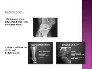 --Radiograph of an
osteochondroma from
the distal femur.
-osteochondroma are
sessile and
pedunculated.
 