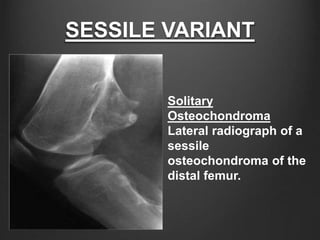 SESSILE VARIANT
Solitary
Osteochondroma
Lateral radiograph of a
sessile
osteochondroma of the
distal femur.
 