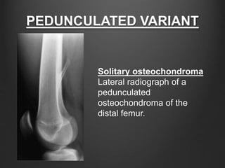 PEDUNCULATED VARIANT
Solitary osteochondroma
Lateral radiograph of a
pedunculated
osteochondroma of the
distal femur.
 