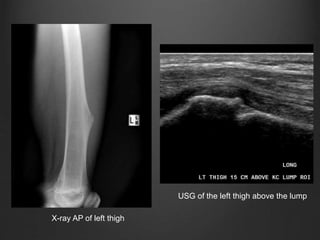 X-ray AP of left thigh
USG of the left thigh above the lump
 