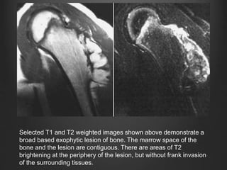 Selected T1 and T2 weighted images shown above demonstrate a
broad based exophytic lesion of bone. The marrow space of the
bone and the lesion are contiguous. There are areas of T2
brightening at the periphery of the lesion, but without frank invasion
of the surrounding tissues.
 