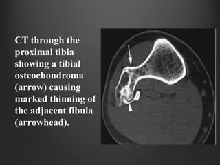 CT through the
proximal tibia
showing a tibial
osteochondroma
(arrow) causing
marked thinning of
the adjacent fibula
(arrowhead).
 