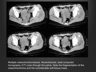Multiple osteochondromatosis. Nonenhanced, axial computed
tomography (CT) scan through the pelvis. Note the fragmentation of the
osteochondroma and the considerable soft-tissue mass.
 