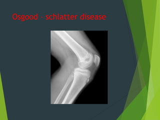 Osgood – schlatter disease
 