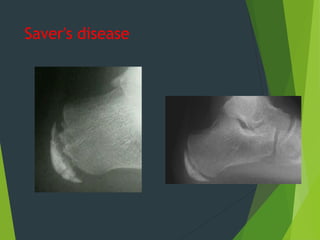 Saver's disease
 