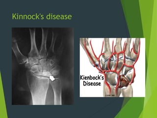 Kinnock's disease
 