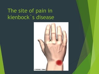 The site of pain in
kienbock`s disease
 