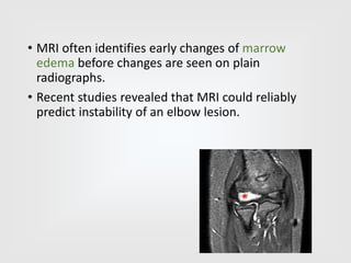 • MRI often identifies early changes of marrow
edema before changes are seen on plain
radiographs.
• Recent studies revealed that MRI could reliably
predict instability of an elbow lesion.
 
