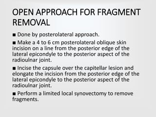 OPEN APPROACH FOR FRAGMENT
REMOVAL
■ Done by posterolateral approach.
■ Make a 4 to 6 cm posterolateral oblique skin
incision on a line from the posterior edge of the
lateral epicondyle to the posterior aspect of the
radioulnar joint.
■ Incise the capsule over the capitellar lesion and
elongate the incision from the posterior edge of the
lateral epicondyle to the posterior aspect of the
radioulnar joint.
■ Perform a limited local synovectomy to remove
fragments.
 