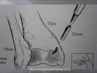 -Técnica de Flick e Gould para criar
um sulco na porção distal da tíbia
- Expõe as lesões posteriores
-Evita osteotomia do maléolo
medial
https://traumatologiaeortopedia.com.br
 