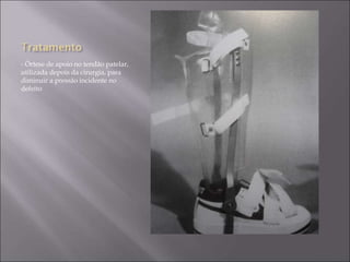 - Órtese de apoio no tendão patelar,
utilizada depois da cirurgia, para
diminuir a pressão incidente no
defeito
 