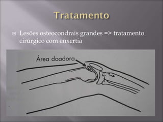  Lesões osteocondrais grandes => tratamento
cirúrgico com enxertia
 