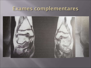  Radiografias oblíquas, em flexão plantar =>
evitam superposição com a tíbia
 Cintilografia
 TC
 RNM
 