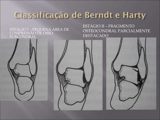 ESTÁGIO I – PEQUENA ÁREA DE
COMPRESSÃO DE OSSO
SUBCONDRAL
ESTÁGIO II – FRAGMENTO
OSTEOCONDRAL PARCIALMENTE
DESTACADO
 