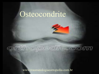 Osteocondrite
www.traumatologiaeortopedia.com.br
 