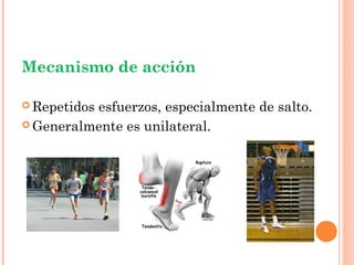 Mecanismo de acción

 Repetidos
          esfuerzos, especialmente de salto.
 Generalmente es unilateral.
 