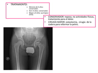 • TRATAMIENTO:
             » Menores de 6 años:
               conservador.
             » De 6- 8 años: conservador.
             » Mayor a 8 años: quirúrgico
               (41%)
                                    •   CONSERVADOR: reposo, no actividades físicas,
                                        tratamiento para el dolor.
                                    •   CIRUGÍA MAYOR: osteotomía, cirugía de la
                                        cadera para reformar la pelvis.
 