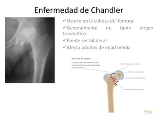 Enfermedad de Chandler
      Ocurre en la cabeza del femoral
      Generalmente      no     tiene  origen
      traumático
      Puede ser bilateral
      Afecta adultos de edad media
 