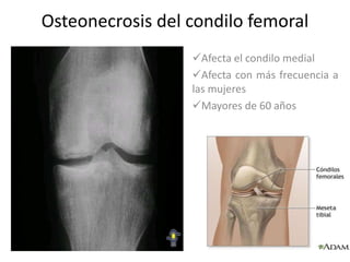 Osteonecrosis del condilo femoral
                  Afecta el condilo medial
                  Afecta con más frecuencia a
                  las mujeres
                  Mayores de 60 años
 