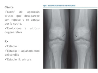 Clínica
Dolor de aparición
brusca que desaparece
con reposo y se agrava
por la noche.
Evoluciona a artrosis
degenerativa

RX
Estadio I
Estadio II: aplanamiento
del cóndilo
Estadio III: artrosis
 