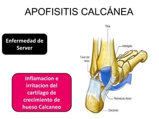 APOFISITIS CALCÁNEA

Enfermedad de
    Server




      Inflamacion e
       irritacion del
        cartilago de
     crecimiento de
     hueso Calcaneo
 