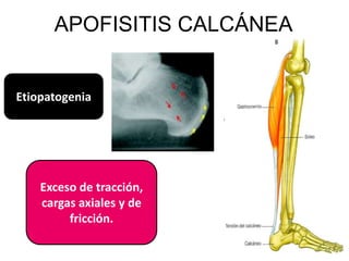 APOFISITIS CALCÁNEA


Etiopatogenia




    Exceso de tracción,
    cargas axiales y de
         fricción.
 