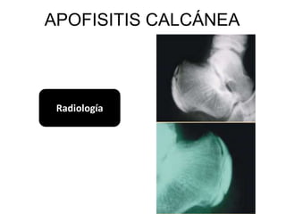 APOFISITIS CALCÁNEA



 Radiología
 