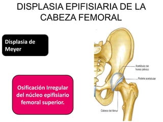 DISPLASIA EPIFISIARIA DE LA
        CABEZA FEMORAL

Displasia de
Meyer




    Osificación Irregular
    del núcleo epifisiario
     femoral superior.
 