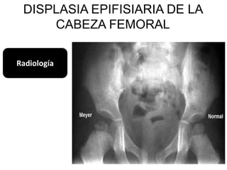 DISPLASIA EPIFISIARIA DE LA
     CABEZA FEMORAL

Radiología
 