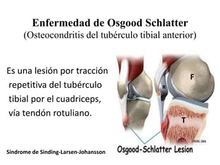 Enfermedad de Osgood Schlatter
      (Osteocondritis del tubérculo tibial anterior)


Es una lesión por tracción
                                                    F
repetitiva del tubérculo                  R

tibial por el cuadriceps,
vía tendón rotuliano.
                                                T


Síndrome de Sinding-Larsen-Johansson
 