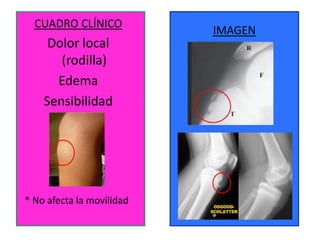 CUADRO CLÍNICO
                           IMAGEN
     Dolor local
       (rodilla)
      Edema
    Sensibilidad




* No afecta la movilidad
 