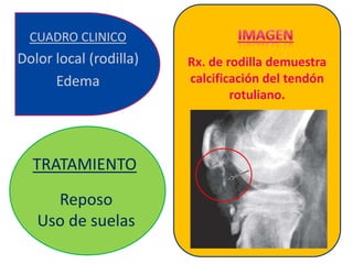 CUADRO CLINICO
Dolor local (rodilla)   Rx. de rodilla demuestra
      Edema             calcificación del tendón
                                rotuliano.




  TRATAMIENTO
     Reposo
   Uso de suelas
 