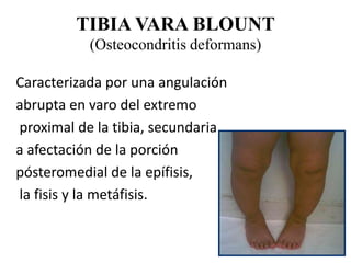 TIBIA VARA BLOUNT
           (Osteocondritis deformans)

Caracterizada por una angulación
abrupta en varo del extremo
proximal de la tibia, secundaria
a afectación de la porción
pósteromedial de la epífisis,
la fisis y la metáfisis.
 