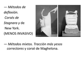— Métodos de
deflexión.
 Corsés de
Stagnara y de
 New York.
(MENOS INVASIVO)

— Métodos mixtos. Tracción más yesos
 correctores y corsé de Maghelona.
 