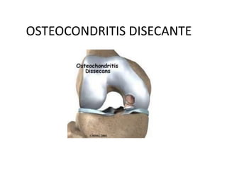 OSTEOCONDRITIS DISECANTE
 
