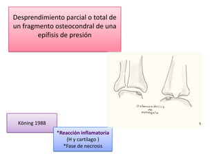Desprendimiento parcial o total de
un fragmento osteocondral de una
        epífisis de presión




 Köning 1988
               *Reacción inflamatoria
                   (H y cartílago )
                 *Fase de necrosis
 