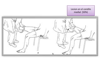 Lesion en el condilo
   medial (50%)
 