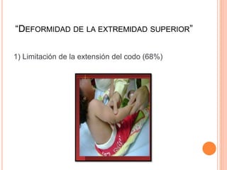 “DEFORMIDAD DE LA EXTREMIDAD SUPERIOR”
1) Limitación de la extensión del codo (68%)
 