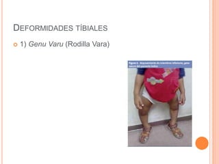 DEFORMIDADES TÍBIALES
 1) Genu Varu (Rodilla Vara)
 